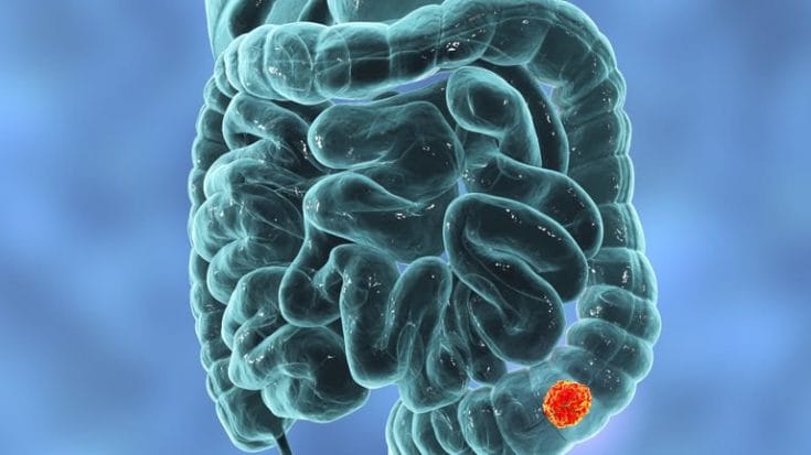 Crean prueba para detectar el cáncer de colon 15 años antes de su aparición